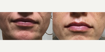 45-54 year old woman treated with Volbella - This female in her late 40's desired a fuller lip and a softening of the fine lines around her mouth. She was injected with 1 syringe of Juvederm Volbella to achieve this result.