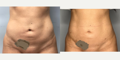25-34 year old woman treated with BodyTite, Laser Liposuction - Patient had liposuction with bodytite