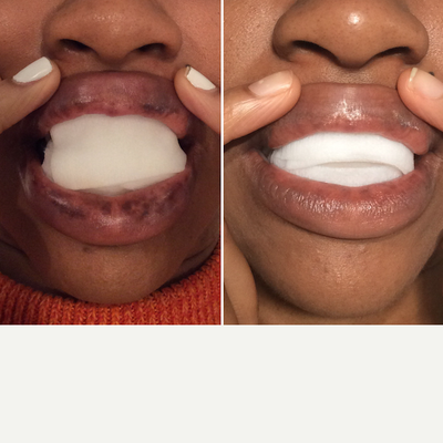 35-44 year old woman treated with Enlighten - Enlighten laser treatment for lip pigmentation.