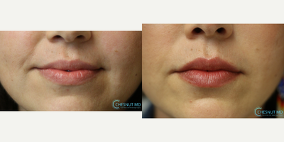 1 year after lip filler - Lip augmentation customized with specific, controlled amounts of different types of filler in different locations over 1 year after injection. No touch-ups were performed.