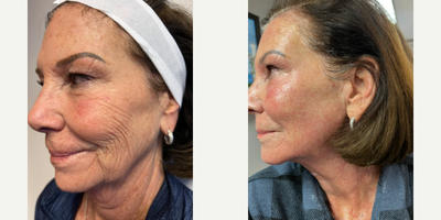 65-74 year old woman treated with Lumecca, IPL, Morpheus8, Microneedling RF - Morpheus Microneedling- Full Face Lifting and Tightening, Under eye fat pads, Skin retexturing
