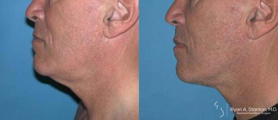 Man treated with Neck Lift - Man treated with Neck Lift