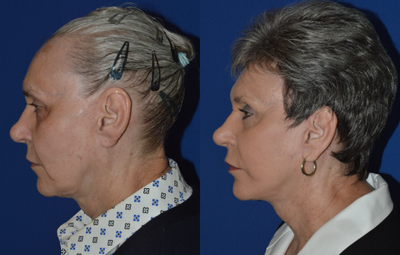 65-74 year old woman treated with Neck Lift - Deep plane face and neck lift performed under local anesthesia.