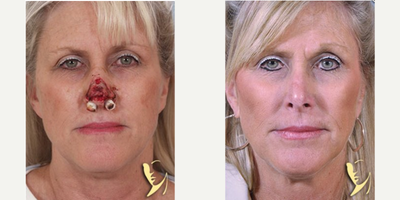 Woman treated with Mohs Surgery - Woman treated with Mohs Surgery