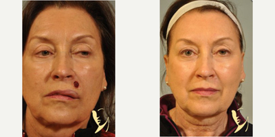 Woman treated with Mohs Surgery - Woman treated with Mohs Surgery