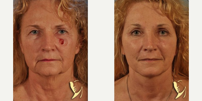 Woman treated with Mohs Surgery - Woman treated with Mohs Surgery