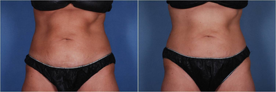 Liposonix to Abdomen - Liposonix