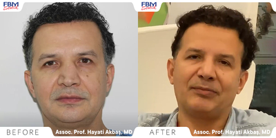 45-54 year old man treated with Revision Rhinoplasty - This patient had a severely deviated septum problem, after his first Rhinoplasty with another surgeon he was still suffering from breathing difficulties. He had his Revision Rhinoplasty and he is happy with the result and breath much better from his nose.