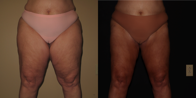 45-54 year old woman treated with Renuvion - Liposuction and Renuvion to inner and anterior thighs on Lipedema patient.