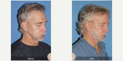 69 year old man treated with Lower Facelift, Neck Lift, Xeomin, PRP Injections - 69 year old man treated with Lower Face and Necklift, Fat Grafting with PRP to Malar and Forehead, Xeomin to Forehead