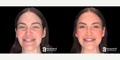 25-34 year old woman treated with Lip Surgery, Lip Reduction - The patient is a 28-year-old female who had concerns about the appearance of her upper and lower lip secondary to permanent filler (Bellafil injections) placed in her lips. Dr. Cho performed an upper and lower lip reduction to address these concerns. The after results are 1 month post-procedure.