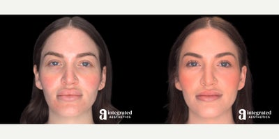 25-34 year old woman treated with Lip Surgery, Lip Reduction - The patient is a 28-year-old female who had concerns about the appearance of her upper and lower lip secondary to permanent filler (Bellafil injections) placed in her lips. Dr. Cho performed an upper and lower lip reduction to address these concerns. The after results are 1 month post-procedure.