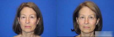 Woman treated with Facelift, Neck Lift, Eyelid Surgery - Woman treated with Facelift, Neck Lift, Eyelid Surgery