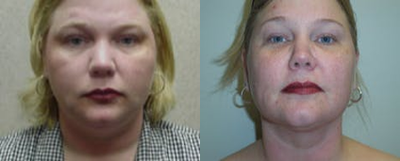 Woman treated with Liposuction - Woman treated with Liposuction to chin area, shown 1 month post op.