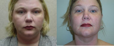 Woman treated with Chin Liposuction - Woman treated with Chin Liposuction, shown 1 month post op.