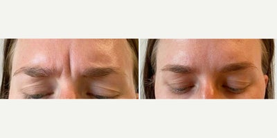 25-34 year old woman treated with Dysport, Botox for Migraines - Dysport treatment with Aubrey Houchin