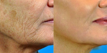 What Do You Wish You Knew Before Having Co2 Laser Co2 Laser Forum