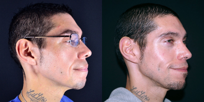 35-44 year old man received treatment for Dimple Creation - 36 year old male received treatment for Dimple Creation