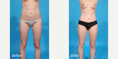 25-34 year old woman treated with Laser Liposuction - Lipoabdominoplasty