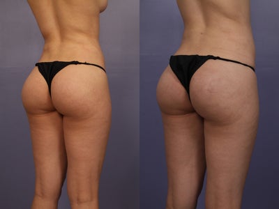 Revison Brazilian Butt Lift for Asymmetry - Early 20s female, underwent liposuction and fat transfer to buttocks (Brazilian butt lift) by another surgeon previously.  Patient came to me for a revision because she noted significant contour irregularities to the love handle area from the previous liposuction and an asymmetry of the buttocks with more upper fullness of on her left buttocks than on her right.  I performed liposuction to her arms, back, love handles, inner thighs and fat transfer to right buttocks for symmetry.