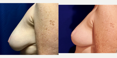 55-64 year old woman treated with Breast Reduction - Bilateral Breast Reduction