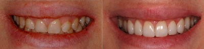 Laser Gum Reshaping, Gingivoplasty, Gingivectomy and Veneers - Patients presented with excessive or uneven gum tissue around upper front teeth. Laser gingivoplasty was done to enhance the balance between teeth and gums. Smile enhancement with Veneers and Laser Gum reshaping (Gingivoplasty)