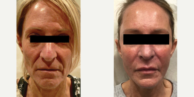 Non-surgical facelift with Sculptra - This patient wanted the results of a facelift without going under the knife. She felt that her face looked heavy and was sinking in. We first rebuilt the structure of the face with Sculptra (3 sessions, 2 months apart) this restored volume, helped with skin integrity, and created width to her face, to gie a more youthful appearance. Then we added a bit of volume to the lips to compliment her face. Toxin was used to smooth out any lines around the forehead and eyes.