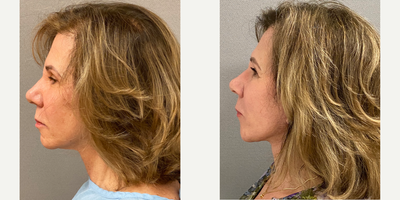 55-64 year old woman treated with Facelift, SMAS Facelift, Neck Lift, Facelift Revision - 62 yo s/p secondary facelift in our on site AAAA certified operating suite under local anesthesia with sedation.