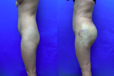 Woman treated with Butt Implants - Woman treated with Butt Implants