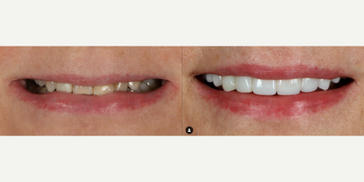Woman treated with Porcelain Veneers, Dental Crown, Smile Makeover - Woman treated with Porcelain Veneers, Dental Crown, Smile Makeover