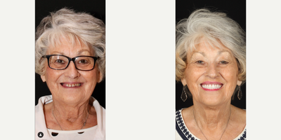 Woman treated with Porcelain Veneers, Dental Crown, Smile Makeover, Dental Implants - Upper and lower dentures supported by dental implants.These pictures were taken a few days apart, and the patient never went without teeth.
