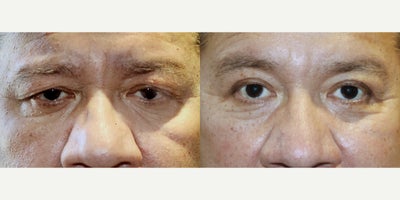 50 year old man treated with Upper Blepharoplasty Surgery - 50 year old man treated with Upper Blepharoplasty Surgery, giving the eyes a more youthful appearance.