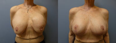 Breast Reconstruction, Implant exchange and breast lift 60 year old woman - 
	Breast Reconstruction, Implant exchange and breast lift 60 year old woman
