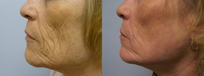 Mixto Laser Resurfacing-Ablative Setting - 
	Mixto Laser Resurfacing-Ablative Setting
