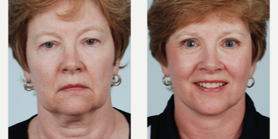 55 year old woman treated with Facelift and Eyelid Surgery - Facelift done