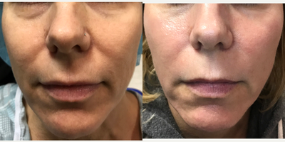 45-54 year old woman treated with CO2 Laser - Fractional CO2 laser resurfacing with SmartSkin and PRP
