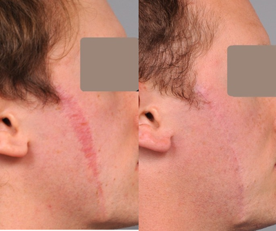 25-34 year old man treated with Scar Removal - Scar Revision on Face