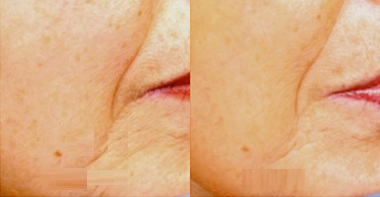 Woman treated with Pelleve - Woman treated with Pelleve