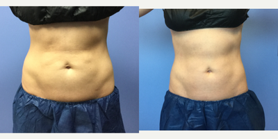 35-44 year old woman treated with CoolTone - 42 year old female treatment with 4 cooltone treatments over 2 weeks.