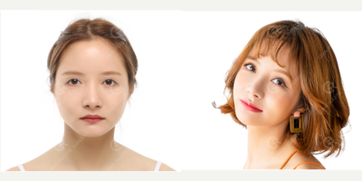 25-34 year old woman treated with V Line Surgery, Cheekbone Reduction - Rhinoplasty, Facial contouring surgery(Jaw reduction, Zygoma Reduction)performed by Seung Ryong Lee MD.