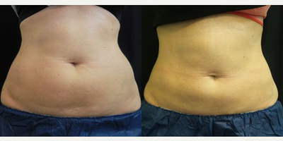 38 year old woman treated with CoolSculpting - Patient treated abdomen, bra rolls, and love handles