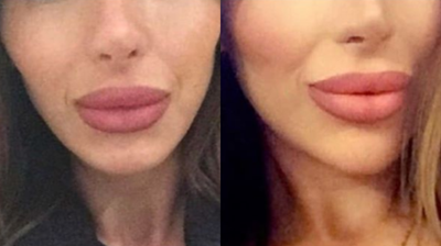 35-44 year old woman treated with Teosyal - Non-Surgical Chin Augmentation
