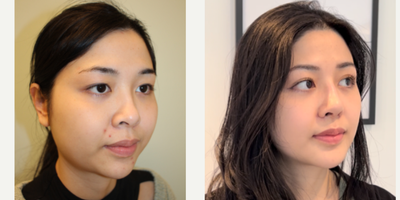 25-34 year old woman treated with Cheekbone Reduction, Genioplasty, Buccal Fat Removal, Jaw Reduction - Facial contouring surgery with combination of several beautifying procedures.