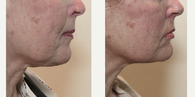 69 year old female treated with Evoke - 69 year old female treated with a series of non-invasive, no downtime radiofrequency treatments using Evoke by InMode to improve the jawline and neck.