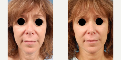 Woman treated with Revision Rhinoplasty - Woman treated with Revision Rhinoplasty