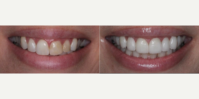Woman treated with Porcelain Veneers, Smile Makeover - Smile makeover with 20 minimal preparation porcelain veneers laser gum recontouring. The patient had old bonding that needed to be replaced and wanted a broader and brighter smile.