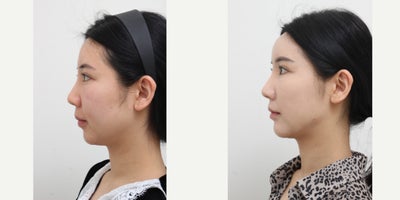 25-34 year old woman treated with Liposuction, Laser Liposuction, Nonsurgical Facelift, AccuLift - 28 Years old female patient Chief Complain: Bulky cheeks, face always looks swelled, face assymetry ( Right side bigger than Letf one), small chine and flat forehead. Treatment Plan: face liposuction (double chin, cheek bone, cheeks)non surgical facelift by fat graft : forehead, nasolabial folds, chinOutcome: face shape balance, reduce exessive fat, more V-lined shape