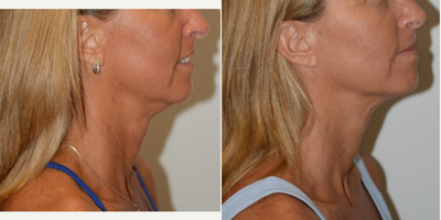 55-64 year old woman treated with Ultherapy - 51 year old patient treated with Ulthera