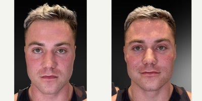 Super Sculpted with Fillers & Biostimulators  - Check out that 90-degree jawline! My patient has been trusting me for years, and today we took his facial sculpting to the next level. After starting with more conservative treatments, we focused on defining his jawline, chin, midface, folds, and templescreating a powerful yet natural look.For men, subtle changes make all the difference. It's all about precision, angles, and enhancing natural proportions without going overboard. The result? Next-level refinement that looks effortless. When you trust an expert with your face, the transformation speaks for itself!