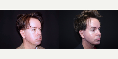 45-54 year old man treated with Facelift, Browlift, Fat Transfer, Genioplasty and Cheek Implants - 53 year old male received a facelift, browlift, fat transfer, genioplasty (chin augmentation) and cheek implants; photos depict the patient's results 3 months post-op.